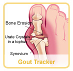 Gout Tracker